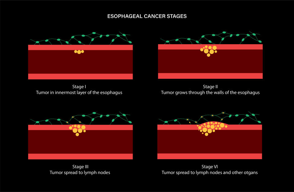 Stages of esophageal carcinoma in the human body. Internal organs exam in clinic. Inflammation, pain, tumor in the digestive system concept. Oesophagus cancer medical poster flat vector illustration.