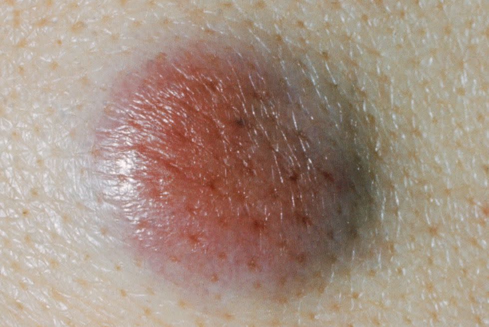 Merkel Cell Carcinoma