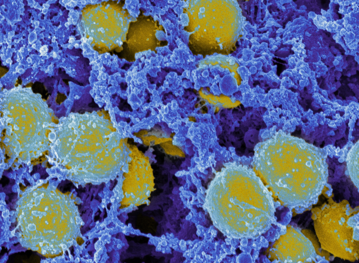 Antimicrobial resistance is now a leading cause of death worldwide due to drug-resistant infections, including drug-resistant strains of tuberculosis, pneumonia and Staph infections like the methicillin-resistant Staphylococcus aureus shown here. (NIAID, cropped from original), <a href="http://creativecommons.org/licenses/by/4.0/" rel="nofollow noopener" target="_blank" data-ylk="slk:CC BY;elm:context_link;itc:0;sec:content-canvas" class="link ">CC BY</a>