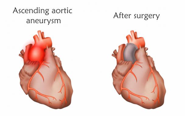 PHOTO: Illustration of an ascending aortic aneurysm before and after repair with a tube graft. (Veronika Zakharova/Getty Images)
