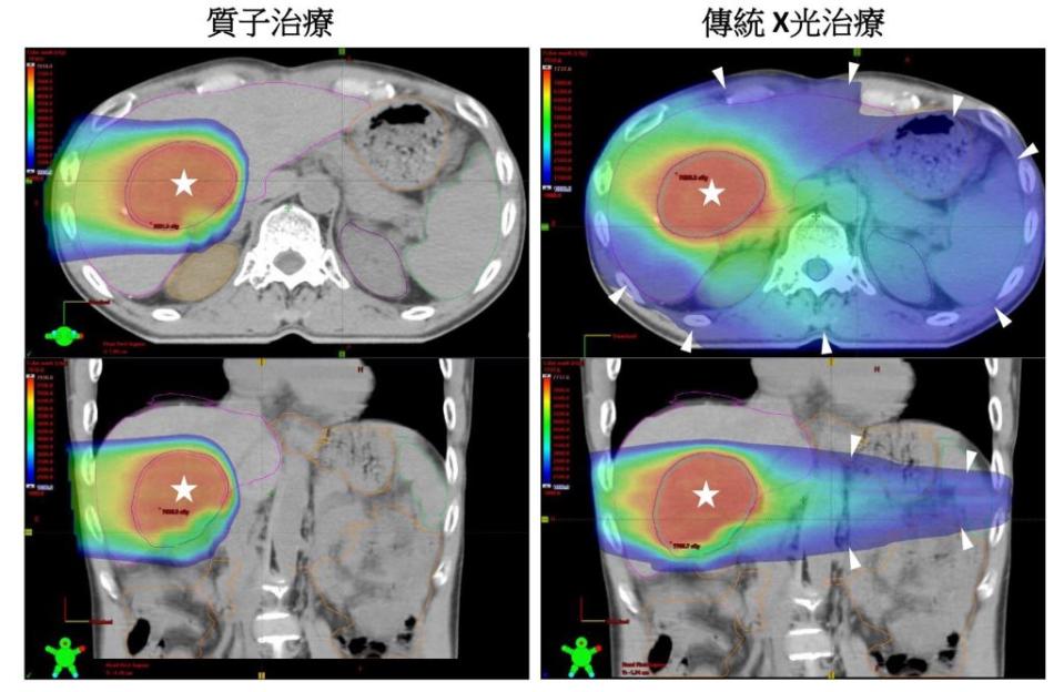 長庚醫院指出，質子治療更能集中狙擊腫瘤(星號)，並降低腫瘤周圍肝臟、腸胃道及脾臟等器官的輻射暴露(箭號彩色區域)，減少副作用。(長庚醫院／提供)