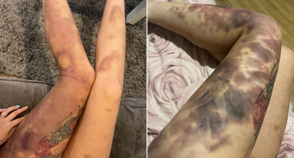 Jessica Davies was left covered in bruises following the attack. (Wales News)