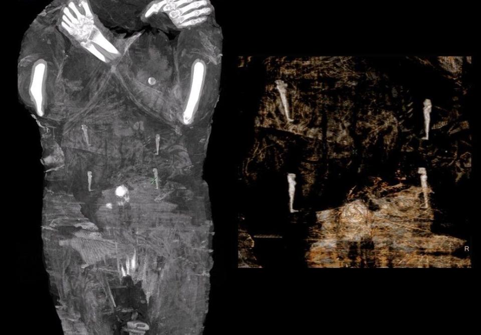 a dark photo of a mummified woman showing a x-ray of her body