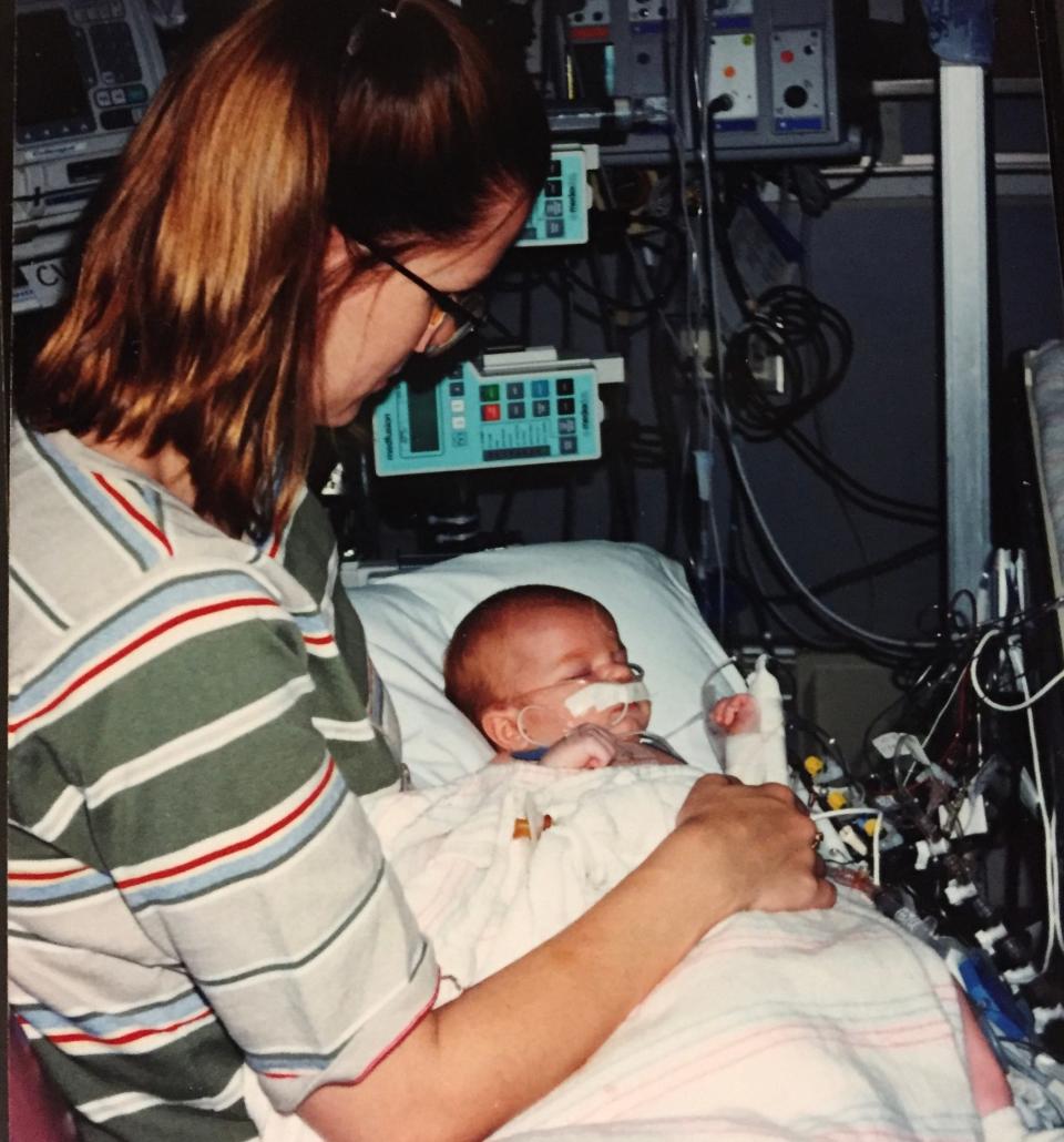 Katherine Schroeder-Herrmann, shown as a baby, had 20 heart procedures by the time she was 22. She was diagnosed with Shone's Complex.