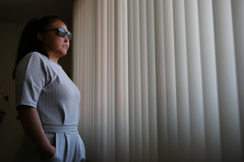 Carmen Sanchez, who survived an acid attack by her ex-partner seven years ago when she was 30, poses for a portrait in Mexico, Sunday, May 30, 2021. Sanchez has undergone 61 surgeries and must protect her skin and right eye from the sun. When Sanchez filed a complaint against her attacker the year she was attacked in 2014, charges of “serious injuries” were not enough to arrest him. But in 2021, an investigation was reopened as an attempted femicide case, for which he was then arrested, and she is waiting to know if he will be formally accused. (AP Photo/Ginnette Riquelme)