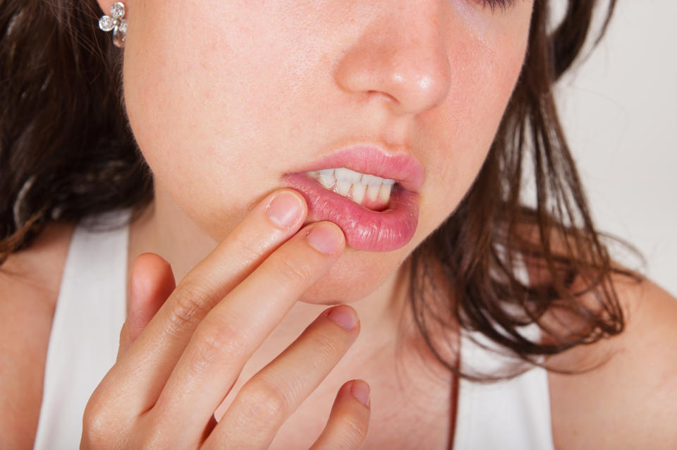 What causes canker sores and how can you get rid of them? Experts weigh in. (Photo: Getty)