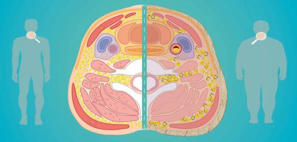 Esta ilustración muestra de forma sencilla la hipótesis de los investigadores sobre las características morfológicas y celulares de los depósitos de grasa en el cuello, en una persona con un peso normal y relativamente sana, y en una persona con obesidad y comorbilidades asociadas. (Imagen: María Jose Arias-Tellez, programa de Biomedicina de la Universidad de Granada/ 'Neck adipose tissue and circumference as predictors of cardiometabolic risk in sedentary adults'). 