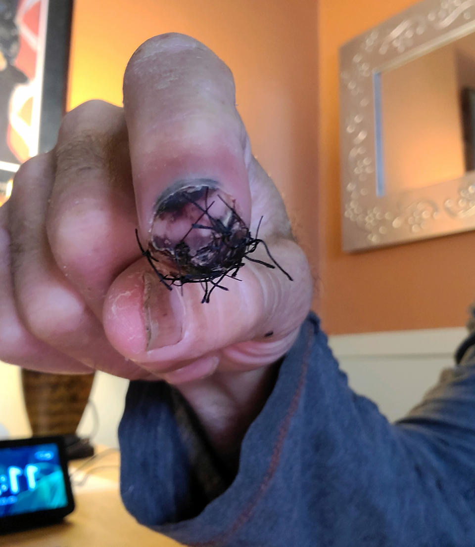 In addition to a traumatic brain injury, Brian Murphy broke his left index finger that required some serious stitches to help it heal. (Courtesy Brian Murphy)