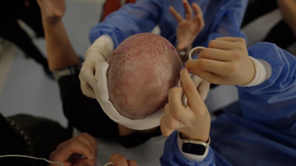 Spencer Macnaughton during a hair transplant in Istanbul Turkey, December 2023