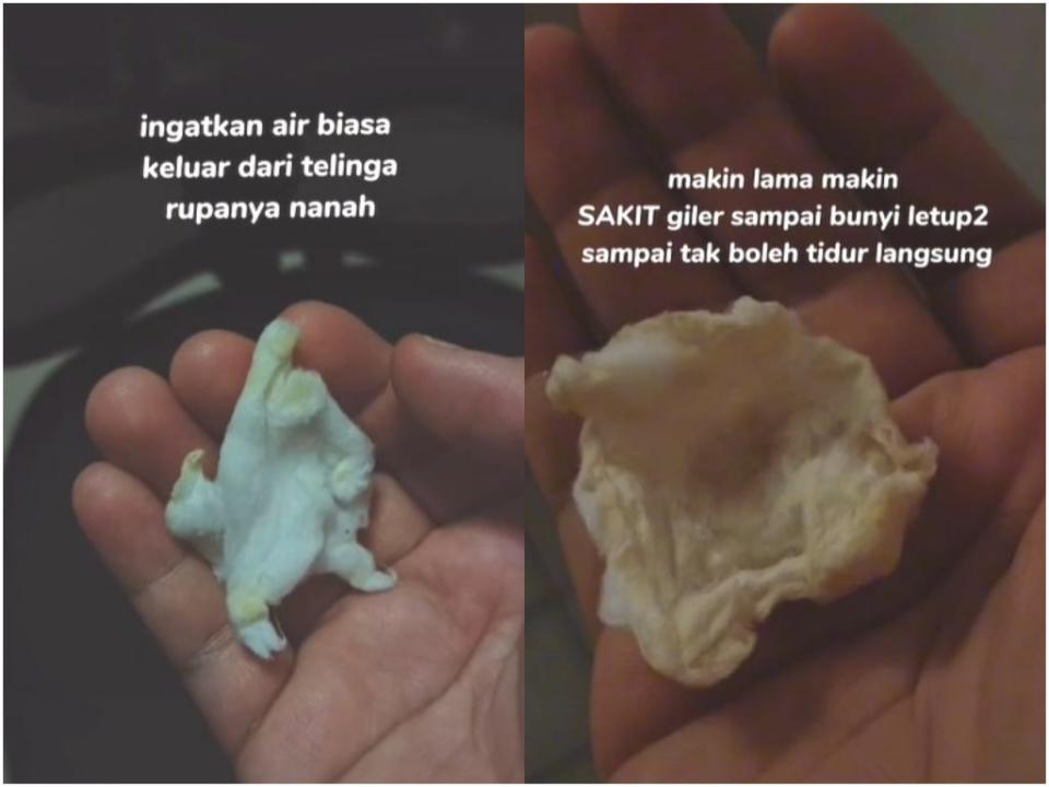 馬來西亞一名女子法麗達（Faridah Arshad），日前用棉花棒清理完耳朵後突然感到劇烈疼痛，且耳朵還不斷流出黃色膿液，結果居然是耳膜被她給挖破了。（圖／翻攝自《sfadaah》TikTok）