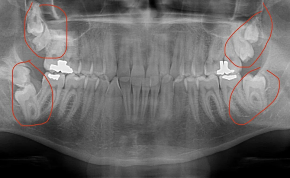 X-ray image of teeth showing four impacted wisdom teeth circled in red