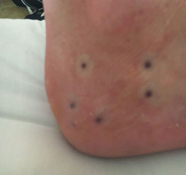 The man posted an image of five marks on his ankle after a swim in the sea. Source: Reddit/weejiemcweejer