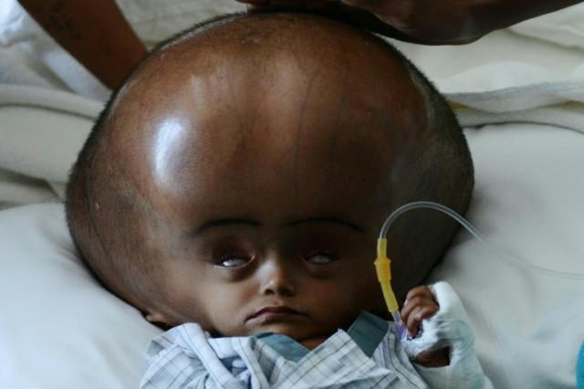 Indian girl with rare head\' condition \'swollen suddenly dies
