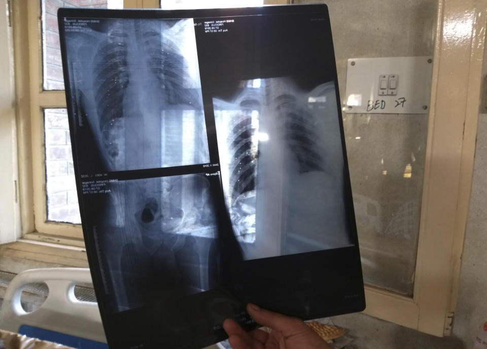 Razir Mir, 32, displays an X-ray of his wife Rabiya as she receives treatment for pellet injuries at the Shri Maharaja Hari Singh hospital in Srinagar, Indian controlled Kashmir, Thursday, Aug. 8, 2019. Mir described hearing a loud bang on Monday and opening his front door to find his wife "face down on the street. Blood was pouring from her eyes," he said. Rabiya, who was left with blurred vision, said that after hearing the government's announcement that Kashmir's special status had been stripped, she thought to buy vegetables, anticipating a long curfew period in Srinagar. "The moment I came out from my house, the soldiers out there shot at my direction," she said, as the couple's 2-year-old cried. (AP Photo/Sheikh Saaliq)