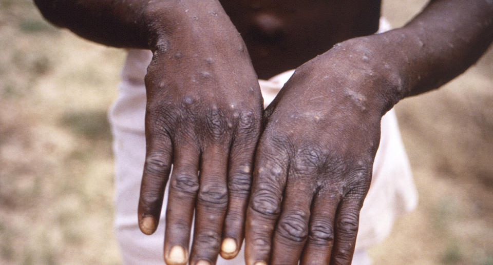 A man's hands with the monkeypox rash