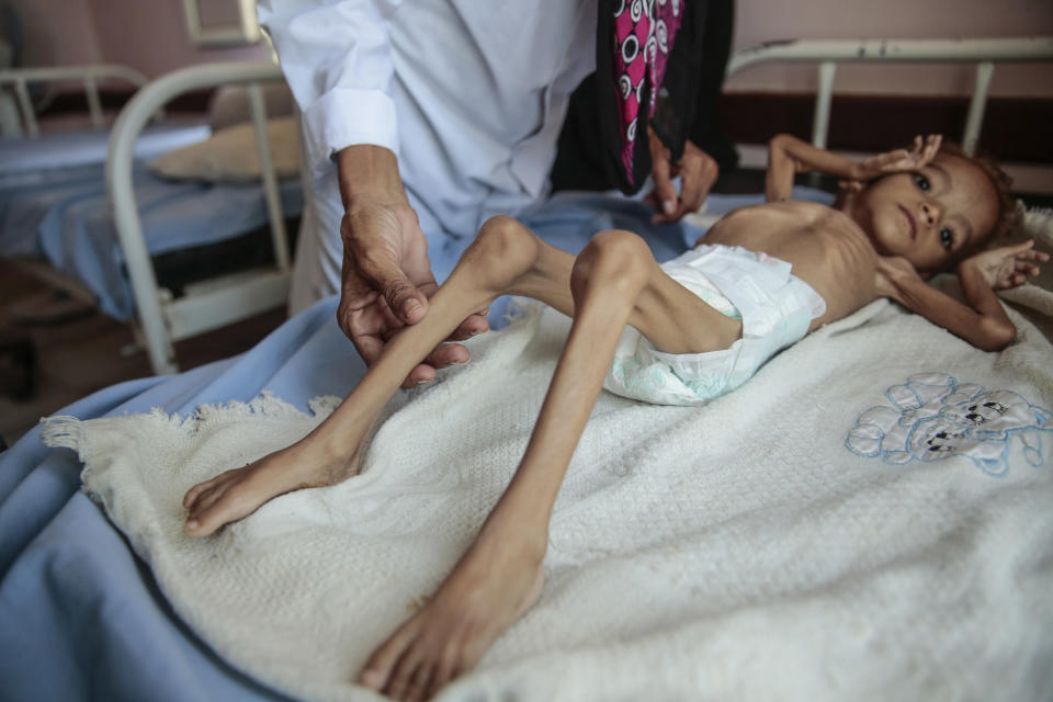 FILE - In this Oct. 1, 2018, file photo, a severely malnourished boy rests on a hospital bed at the Aslam Health Center in Hajjah, Yemen. A leading aid organization on Monday, Jan. 11, 2021 warned that U.S. Secretary of State Mike Pompeo's move to designate Yemen’s Iran-backed Houthi rebels as a “foreign terrorist organization” would deal another “devastating blow" to the impoverished and war-torn nation. (AP Photo/Hani Mohammed, File)