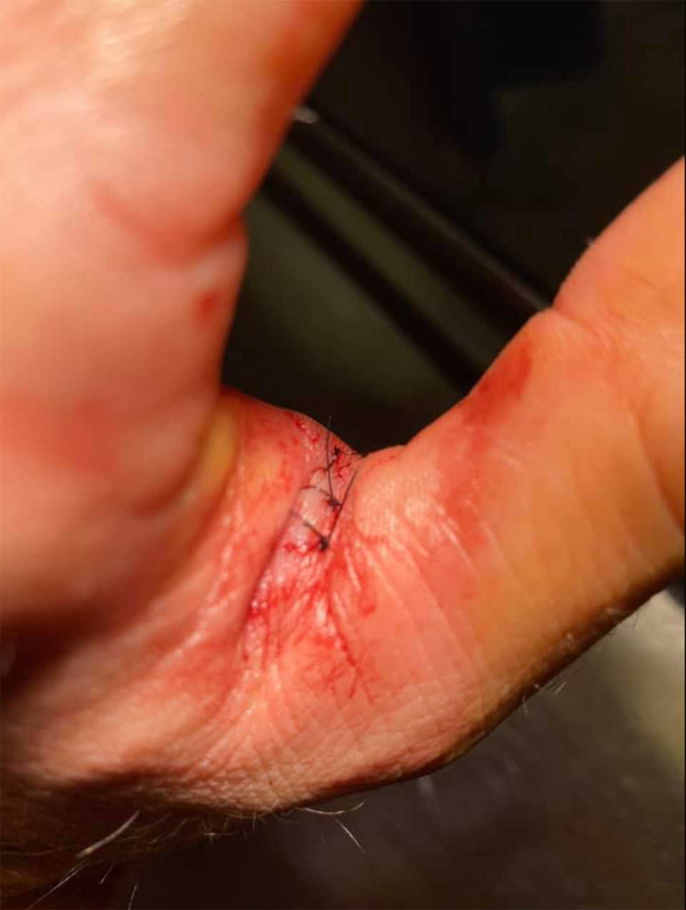 Stitches in the webbing of Dylan's hand.