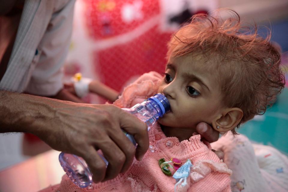 A father gives water to his malnourished daughter at a feeding center in a hospital in Hodeida, Yemen: AP