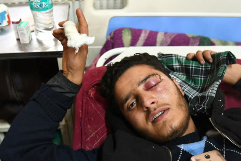 Shahid Ahmad, 16, was treated in Srinagar's main hospital after his left eye was damaged by pellets fired by Indian government forces