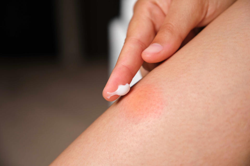 A close-up of a hand applying a small amount of white cream to a red, irritated patch of skin