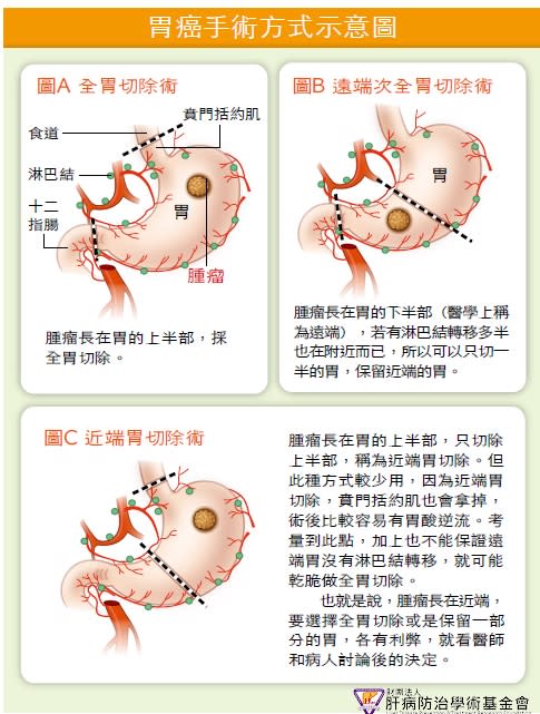 胃癌手術方式示意圖