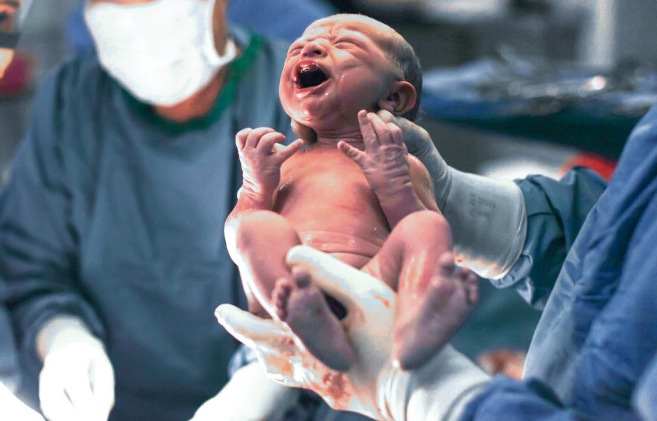 A new study from the <em>Lancet</em> found that C-section rates have doubled worldwide. (Photo: Petri Oeschger/Getty Images)