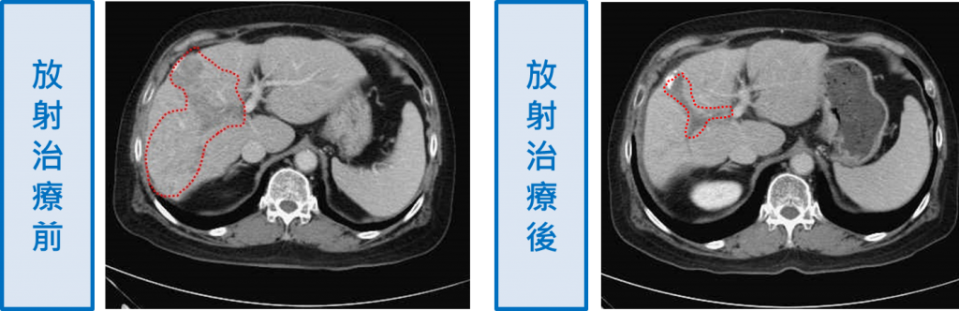 葉先生治療照。（記者徐義雄翻攝）