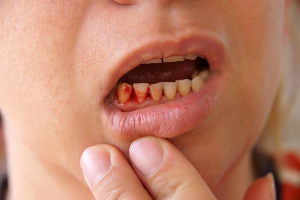 Bleeding from the oral cavity- Dental emergencies