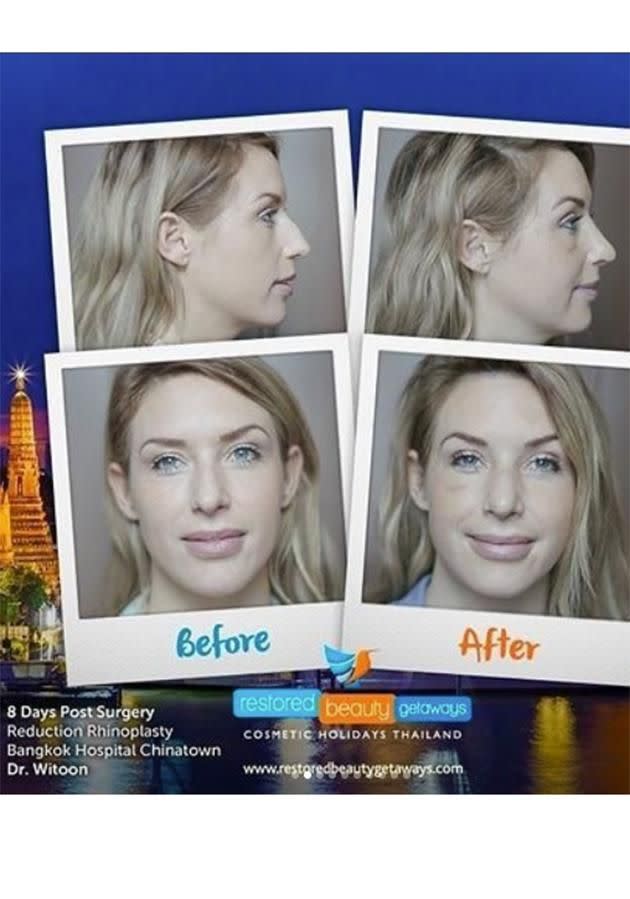 Before and after pics of her nose. Source: Instagram