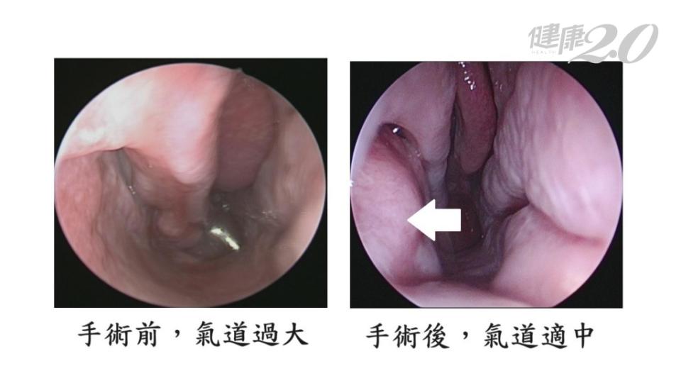 空鼻症手術後改善