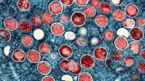 PHOTO: A colorized transmission electron micrograph shows monkeypox particles (red) found within an infected cell (blue), cultured in the laboratory that was captured and color-enhanced at the NIAID Integrated Research Facility in Fort Detrick, Md. (NIAID via AP)