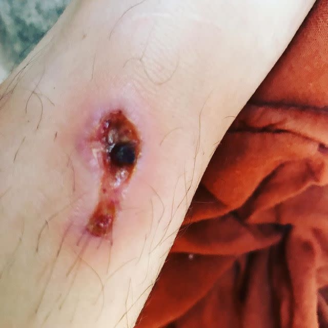 Pictures of Spider Bites