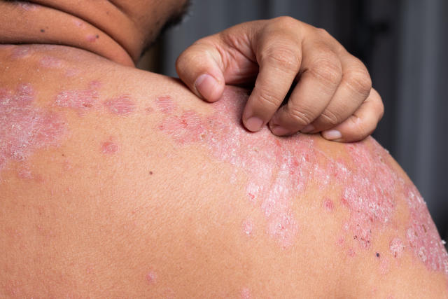 Psoriasis: Is sun good or bad?