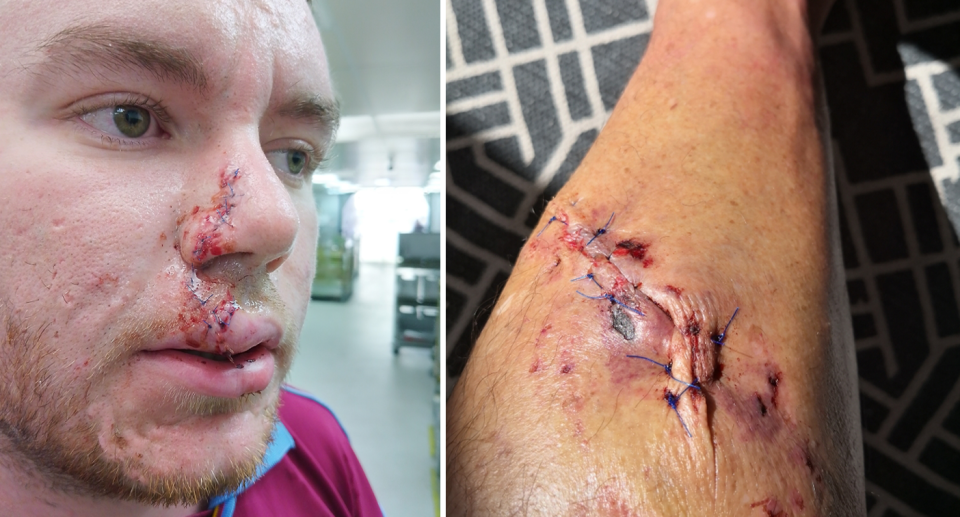 A man with face stitches after being attacked by a dog (left) and a leg with stitches in it (right). 