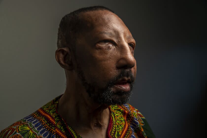 PARAMOUNT, CA-JULY 17, 2023: Robert Chelsea, 72, the first African American to be a full transplant recipient and the oldest face transplant recipient in the world, is photographed at his home in Paramount. Chelsea suffered serious burns in a 2013 crash. (Mel Melcon / Los Angeles Times)