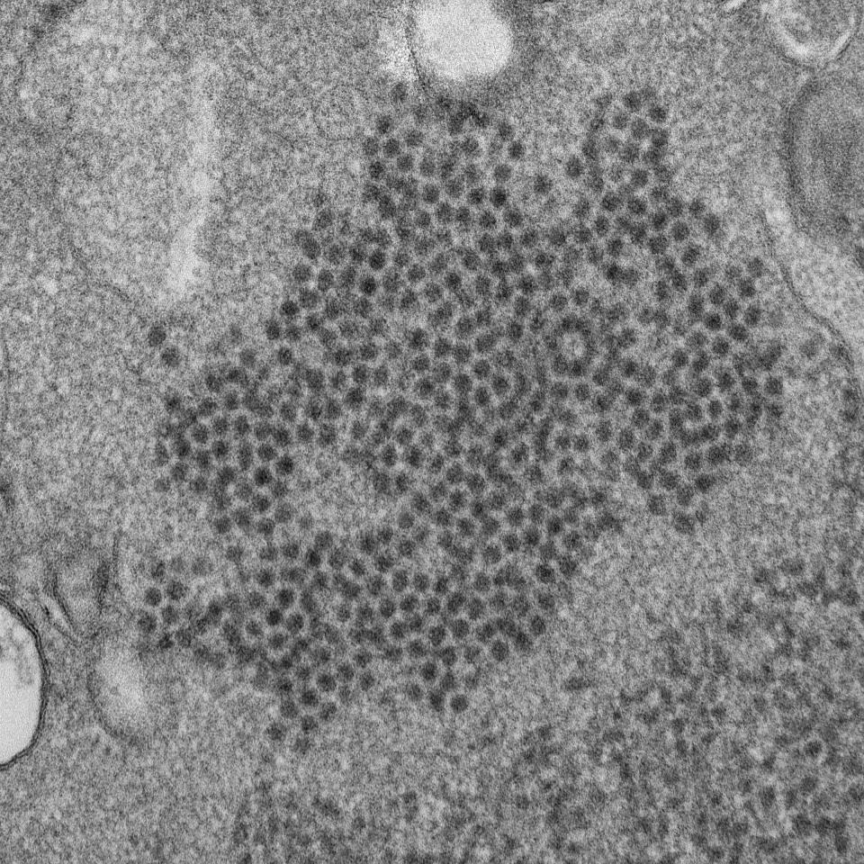 FILE - This 2014 file electron microscope image made available by the Centers for Disease Control and Prevention shows numerous, spheroid-shaped Enterovirus-D68 (EV-D68) virions. Doctors have suspected a mysterious paralyzing illness, acute flaccid myelitis, might be tied to the virus. This year has seen a record number of cases of the mysterious paralyzing illness in children, U.S. health officials said Monday, Dec. 10, 2018. (Cynthia S. Goldsmith, Yiting Zhang/CDC via AP, File)
