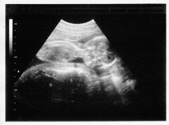 Ultrasound Image - Prenatal Testing