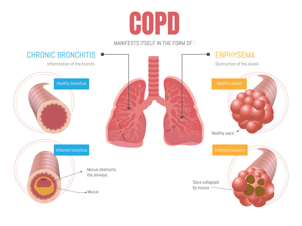 COPD infographic comparing emphysema and bronchitis. (Photo via Getty Images)