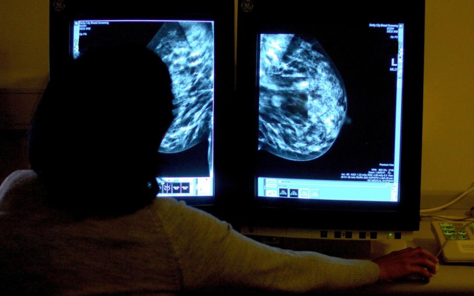 A consultant studying a mammogram of a woman's breast. - RUI VIEIRA/PA WIRE