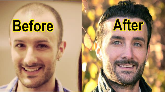 Musician David DiMuzio before and after hair transplants. These photos were taken over 10 years apart. “Even the scar is covered up by hair, and the hair looks great now,” he told HuffPost. (Photo: David DiMuzio)