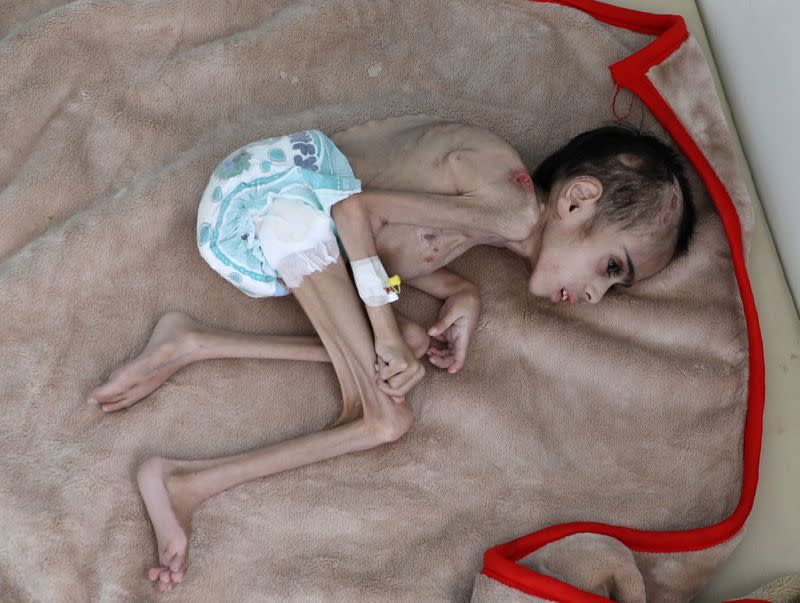 FILE PHOTO: Faid Samim, 7, a malnourished boy who also has cerebral palsy, lies on a bed at the malnutrition treatment ward of al-Sabeen hospital in Sanaa