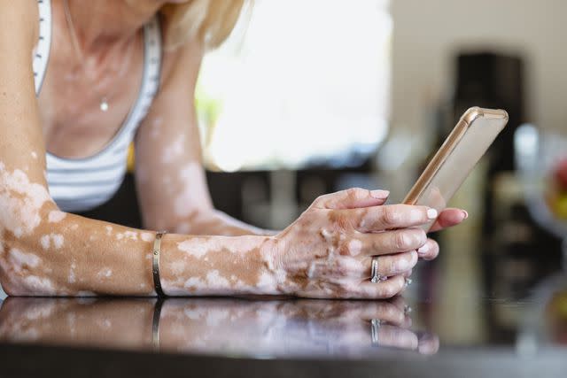 <p>SolStock / Getty Images</p> Female with vitiligo on her arms and hands holding a phone