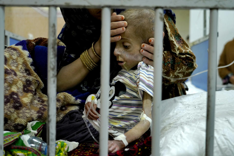 An Afghan mother helps her malnourished boy in he Indira Gandhi hospital in Kabul, Afghanistan, Sunday, May 22, 2022. Some 1.1 million Afghan children under the age of five will face malnutrition by the end of the year. , as hospitals wards are already packed with sick children . (AP Photo/Ebrahim Noroozi)