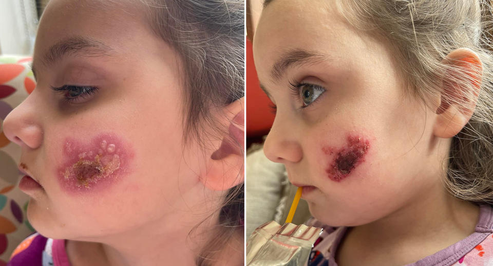 Aubree's cheek is covered in a blistery rash as she is diagnosed with herpes simplex virus.