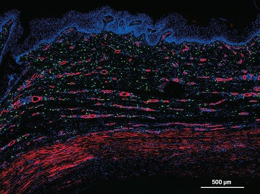 An engineered human artery cultured from human vascular cells and implanted into a patient.