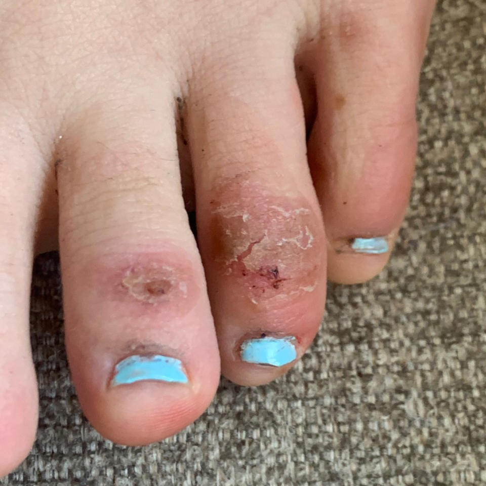 This April 21, 2020 photo provided by Northwestern University shows discoloration on a teenage patient's toes 4 weeks after the onset of the condition informally called "COVID toes." The red, sore and sometimes itchy swellings on toes look like chilblains, something doctors normally see on the feet and hands of people who’ve spent a long time outdoors in the cold. (Courtesy of Dr. Amy Paller/Northwestern University via AP)