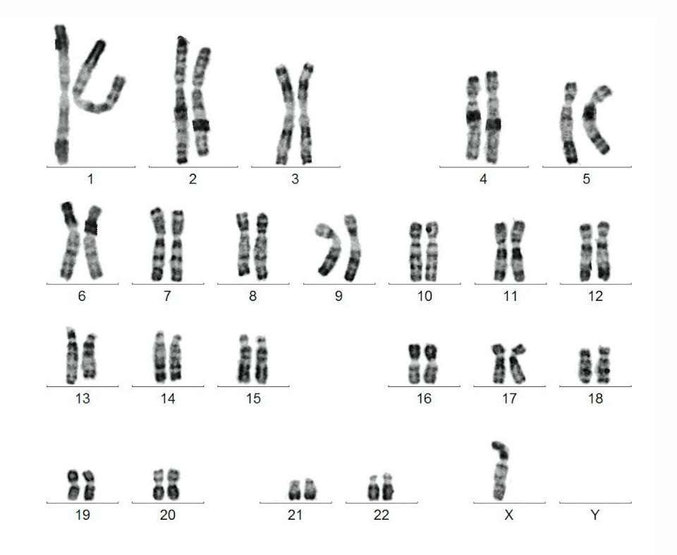 Screening for Y chromosome loss could help lead to earlier treatments for age-related conditions. <a href="https://www.gettyimages.com/detail/photo/digitally-generated-image-of-karyotype-over-white-royalty-free-image/649121991" rel="nofollow noopener" target="_blank" data-ylk="slk:Olympia Valla/EyeEm via Getty Images;elm:context_link;itc:0;sec:content-canvas" class="link ">Olympia Valla/EyeEm via Getty Images</a>