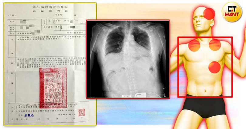 陳父被狗追導致摔車，傷勢嚴重，卻因無人承認是狗飼主，導致數萬元的醫療費求償無門。(圖／張進安攝、讀者提供)