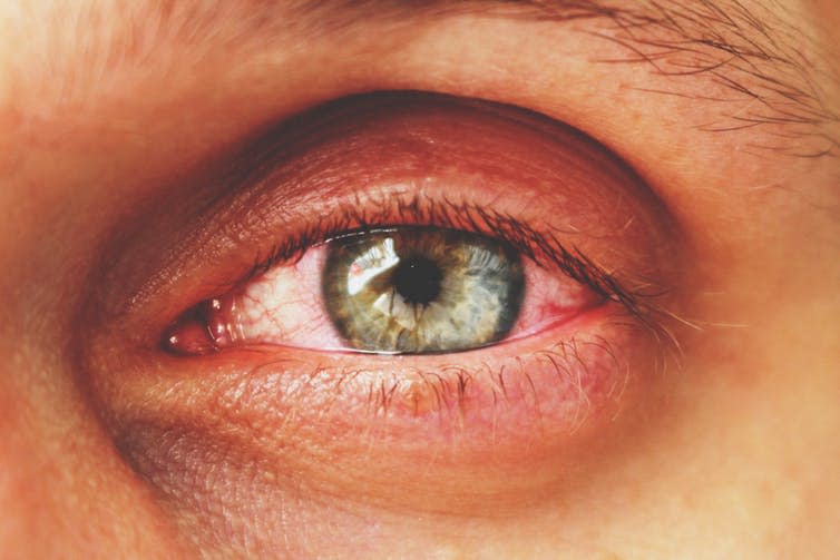 <span class="caption">Pink eye is just one of the risks of using contaminated eye makeup.</span> <span class="attribution"><a class="link " href="https://www.shutterstock.com/download/confirm/1048226590?src=671bdaf7-ff44-476b-8d0c-85949f70b3ed-1-0&size=medium_jpg" rel="nofollow noopener" target="_blank" data-ylk="slk:Sergey Granev/Shutterstock;elm:context_link;itc:0;sec:content-canvas">Sergey Granev/Shutterstock</a></span>