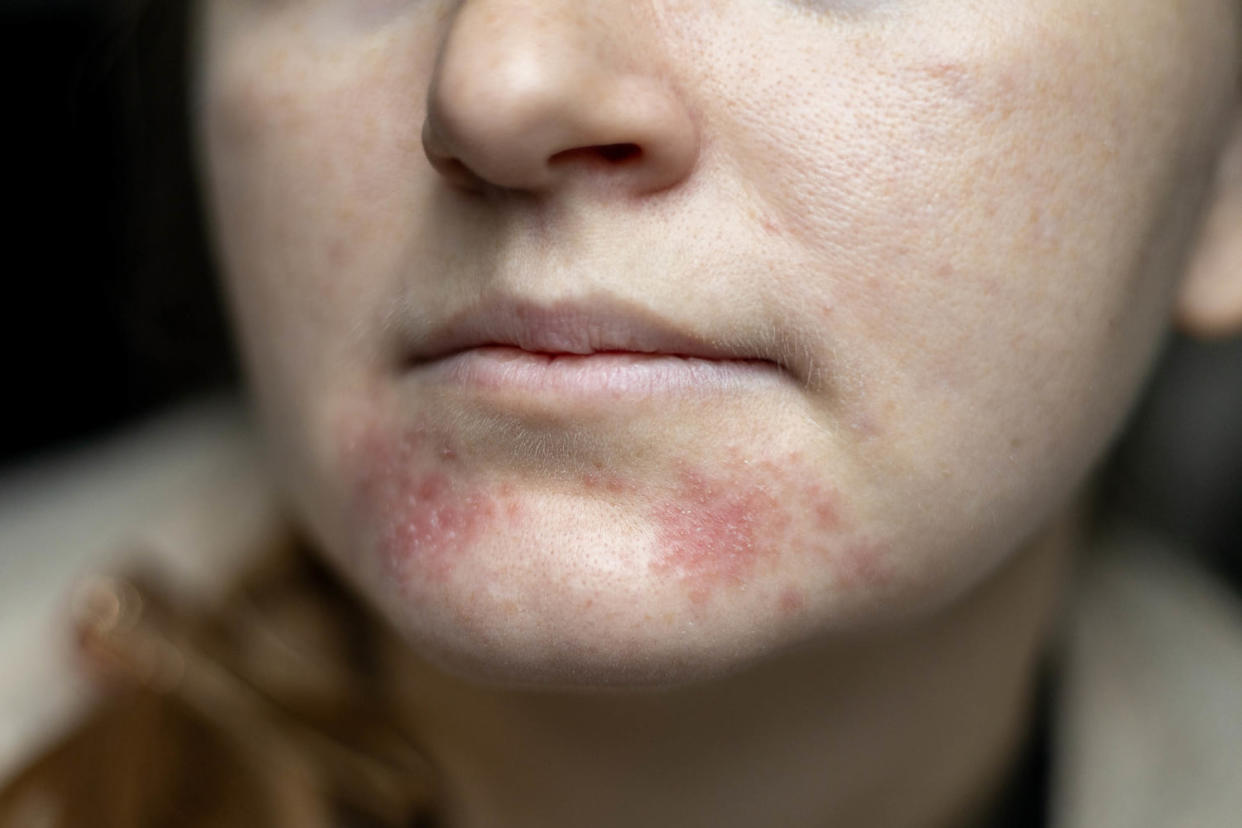Perioral dermatitis  (Mariia Skovpen / Getty Images)